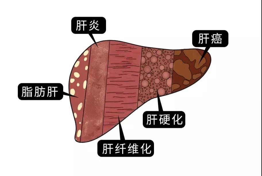 脂肪肝的最大敵人不是肥胖，答案竟是這樣！