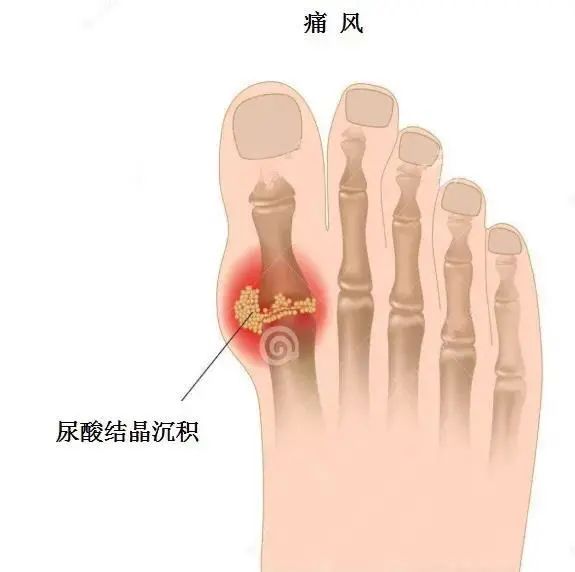 痛風為什么偏愛男性？你最關(guān)心的問題都在這里