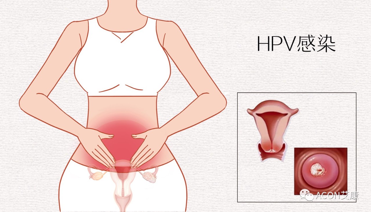HPV轉(zhuǎn)陰其實很簡單， 女性必知的宮頸癌真相